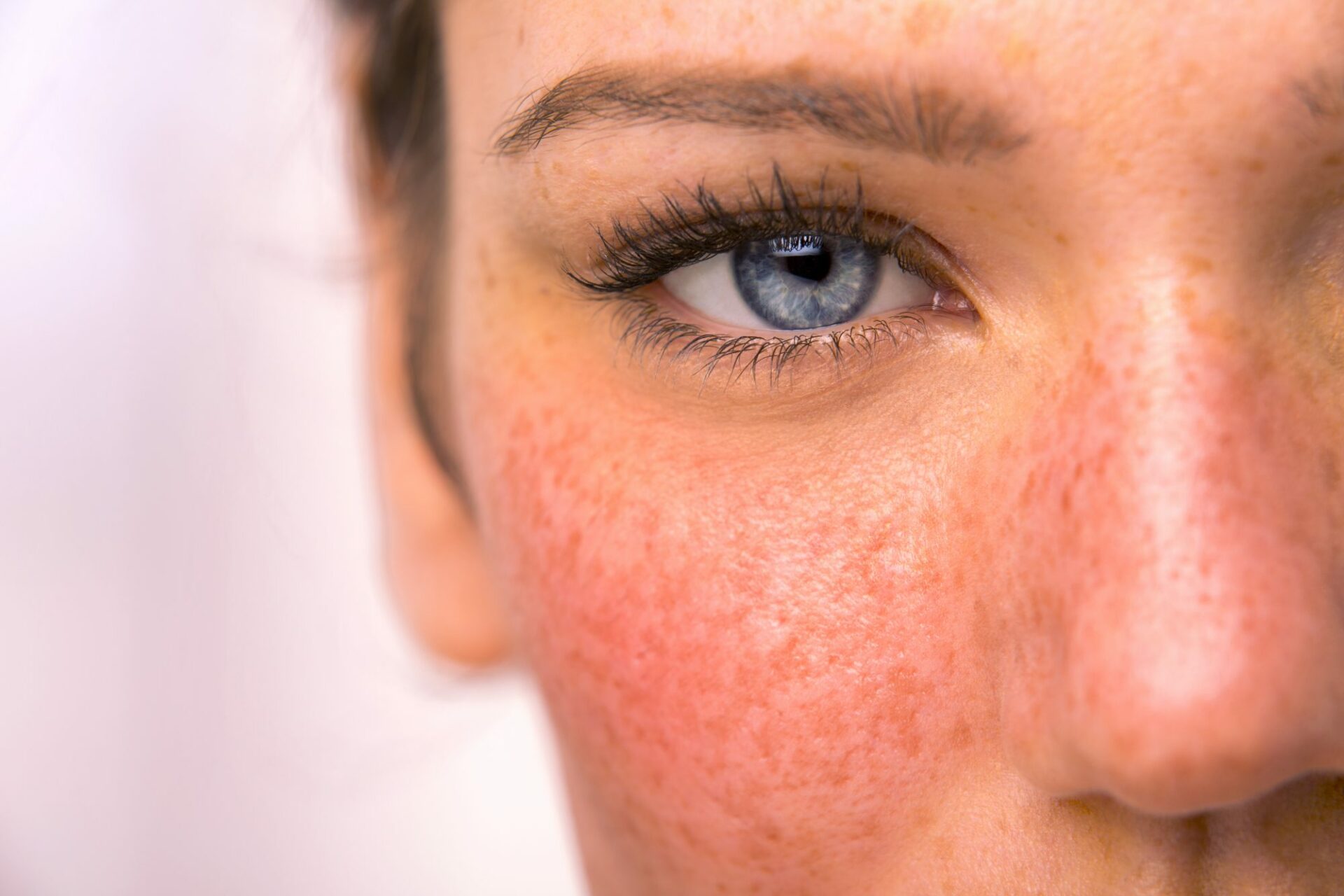 Rosacea Treatment