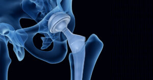 Introduction to Hip Replacement Surgery