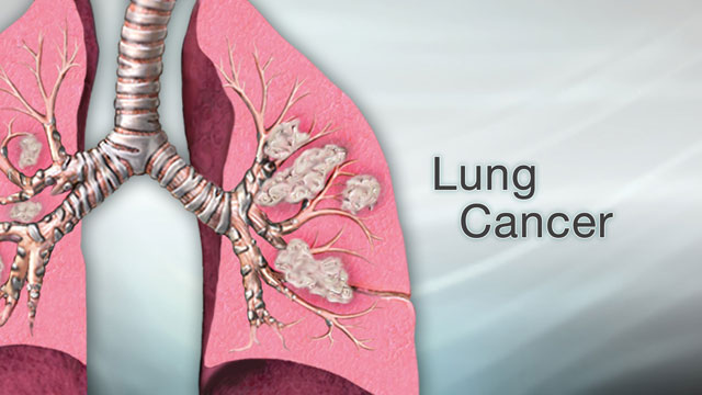 Lung Cancer: Understanding the Disease, Its Causes, Symptoms, and Treatments