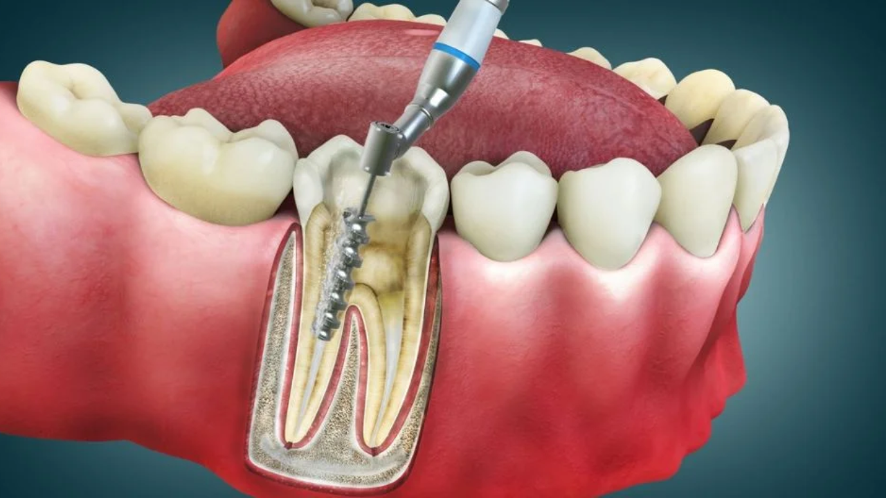dental root canal treatment