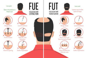 FUE vs FUT: Which Hair Transplant Method Is Right for You?
