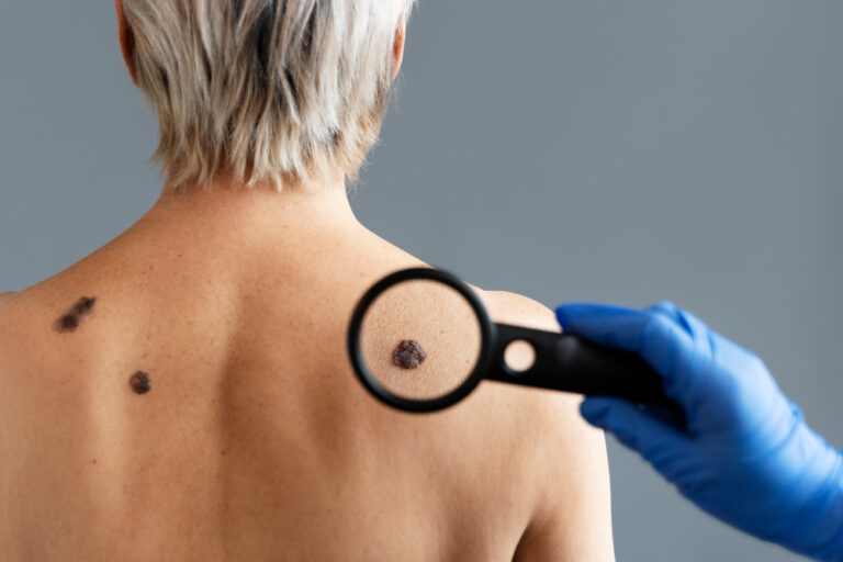 What Are the 7 Warning Signs of Skin Cancer?