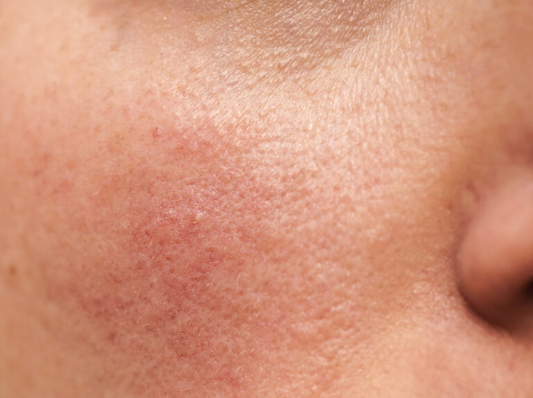 Investigating the Effectiveness of Natural Remedies for Rosacea Treatment