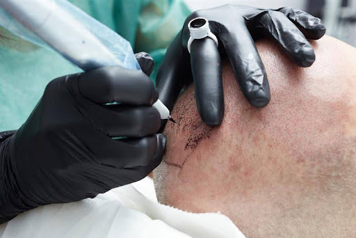 How SMP Can Camouflage Scars from Hair Transplants