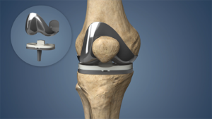 Why Experience Matters When Choosing a Knee Replacement Surgeon?