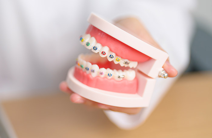 Why Tooth Movement Requires Different Braces for Different Cases