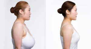 Plastic Surgery: Breast Reduction and Wide Nose Rhinoplasty Explained