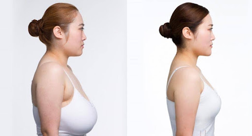 Plastic Surgery: Breast Reduction and Wide Nose Rhinoplasty Explained